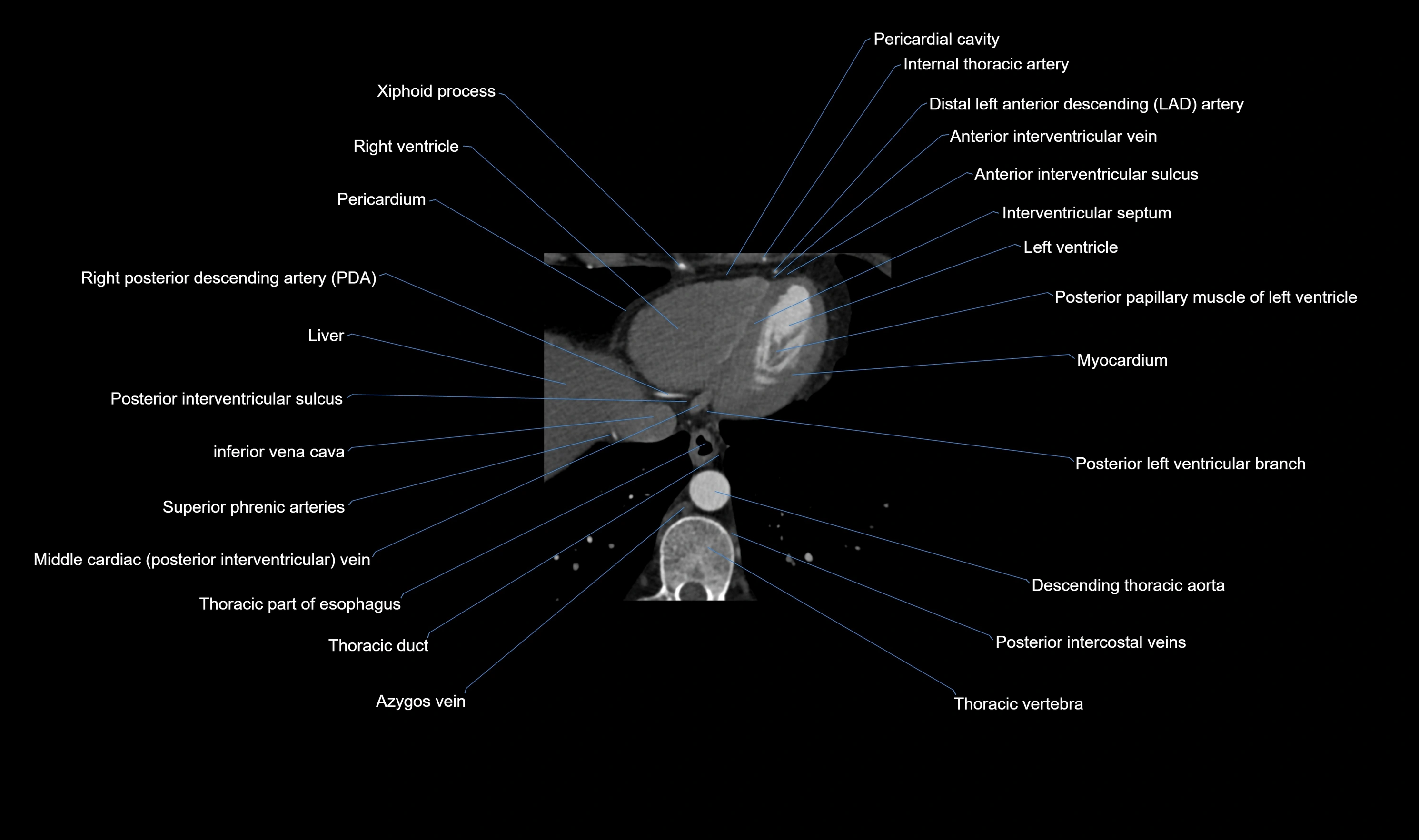 CT heart (coronary angiogram) axial view cross sectional anatomy labelled radiology image-00060.webp